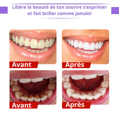 Glory smile pour donner de l'éclat à vos dents